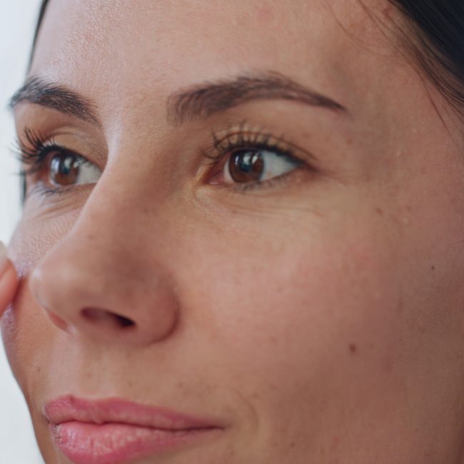 usuwanie naczynek w klinice medycy estetycznej roseti med&beauty