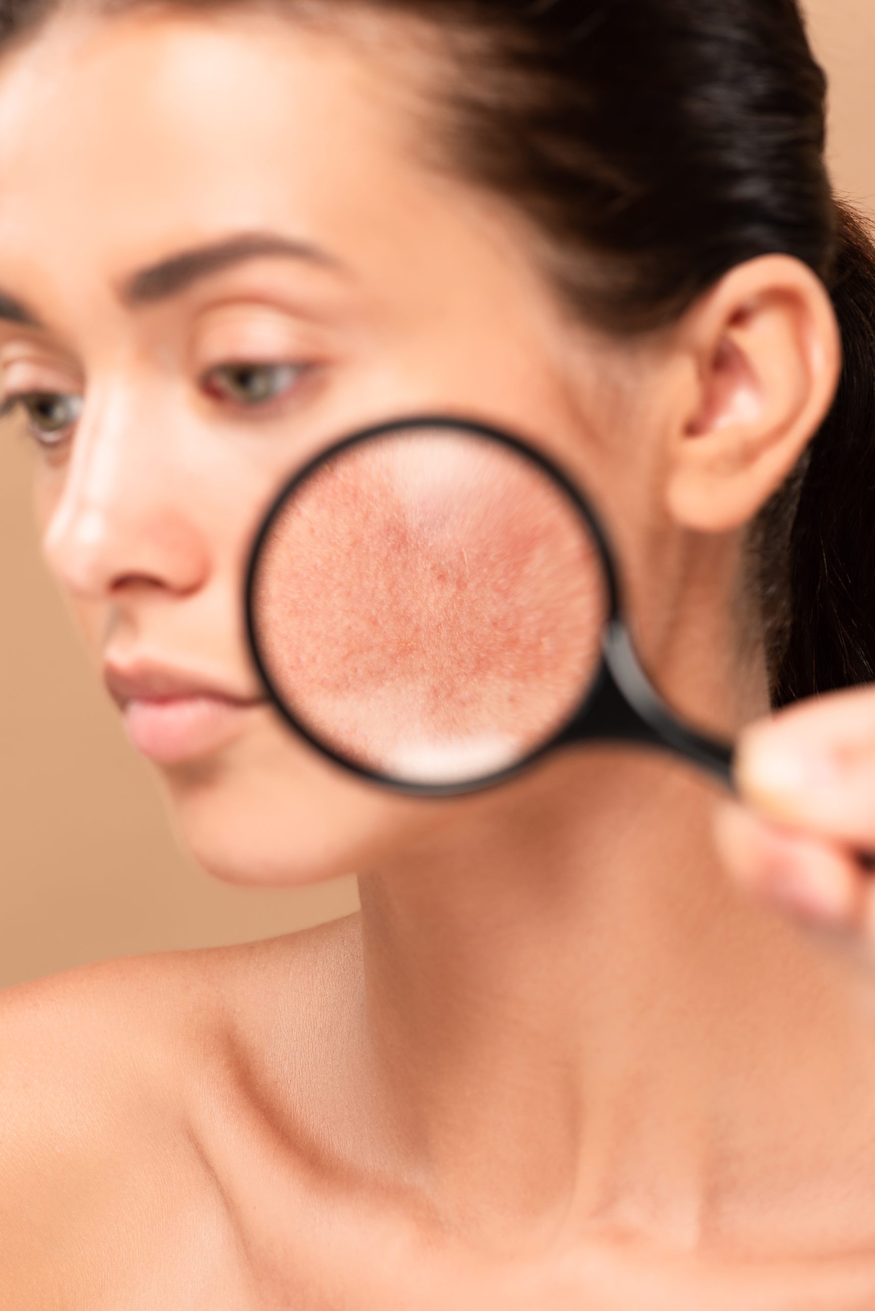 usuwanie naczynek w klinice medycy estetycznej roseti med&beauty
